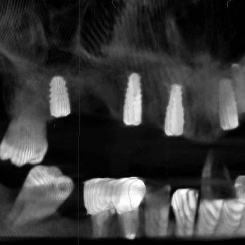 Lateral X-ray view showing four dental implants in the upper jaw and a combination of natural and restored teeth in the lower jaw.