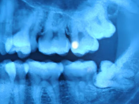 Radiografía dental azul de dientes y muela del juicio impactada en la parte inferior derecha.