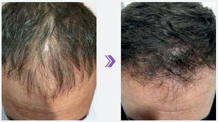 Hairfiller til uønsket hårtab