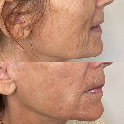 Før og efterbilleder af Bloom Skinbooster 2.0 hos Bloom Copenhagen