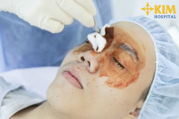 Chích lấy mỡ mí mắt có nguy hiểm không (3)