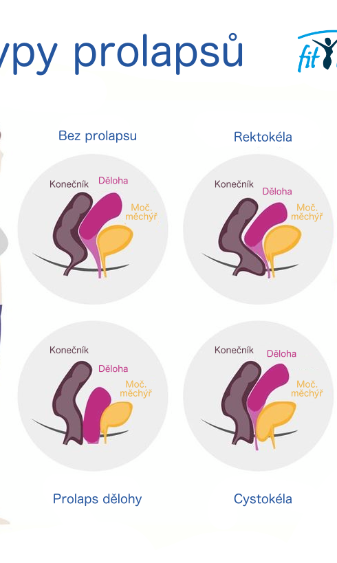 Typy prolapsů.PNG