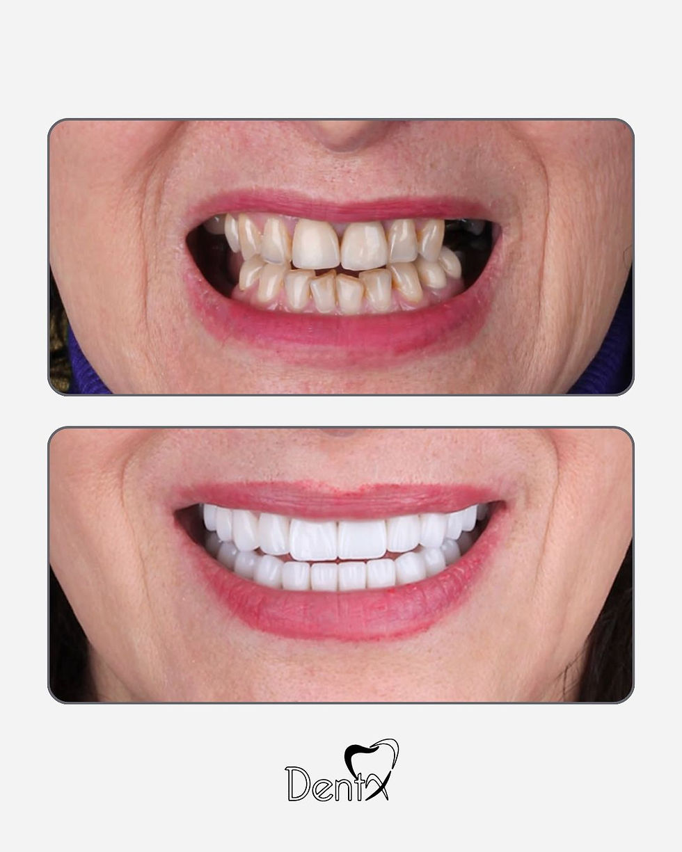 alt=“Фото до и после комплексного лечения: сверху — выраженная неровность и потемнение зубов, снизу — ровные белые зубы после установки керамических коронок”