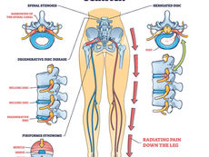 What causes Sciatica to Flare Up?