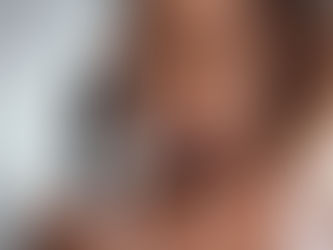 Hair loss in women can severely affect emotional well-being and quality of life