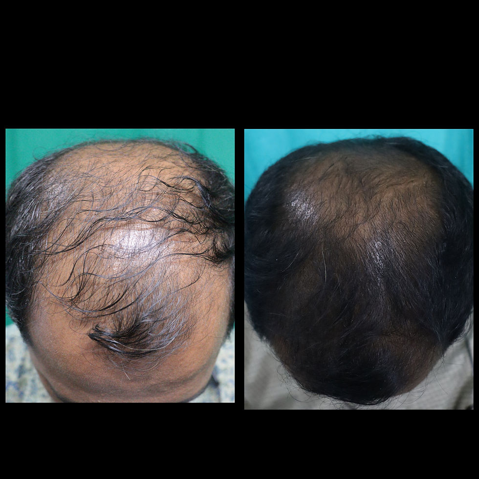 Hairloss Treatment