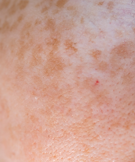 Uneven skin tone.png