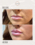 Lip Filler: Kylee Ploessl, RN