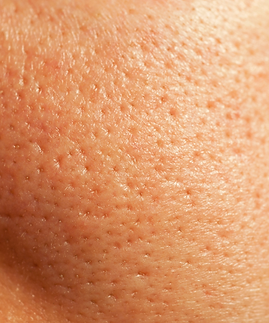Enlarged facial pores.png
