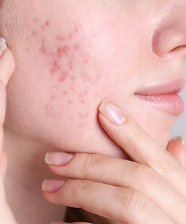Acne scarred skin.png