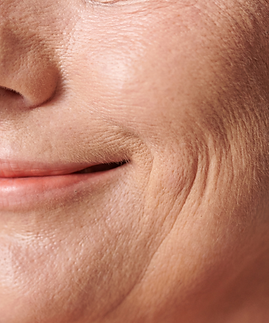 Skin laxity.png