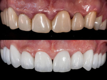 coroane dentare, fatete dentare, dentist
