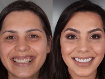 coroane dentare, fatete dentare, dentist Botosani
