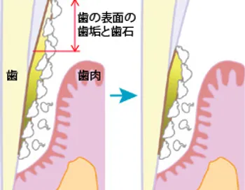 むし歯菌・歯周病原菌を取り除くには、器具や機械を使って病原菌の塊である歯垢(プラーク、バイオフィルム)を取り除き、歯垢が停滞する足場になっている歯石を取り除く」方法しかありません。その一つがスケーリングです。です。