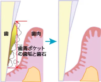 むし歯菌・歯周病原菌を取り除くには、器具や機械を使って病原菌の塊である歯垢(プラーク、バイオフィルム)を取り除き、歯垢が停滞する足場になっている歯石を取り除く」方法しかありません。その一つがスケーリング ルート プレーニングです。