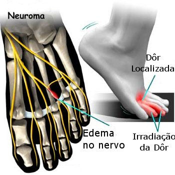 CRISTIANE LEÃO - NEUROMA DE MORTON