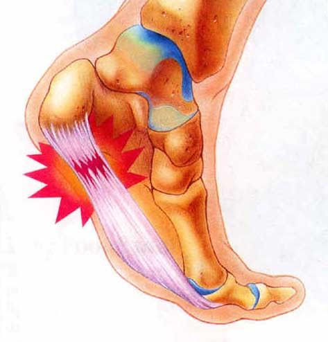 AUGUSTO MORENO - FASCITE PLANTAR