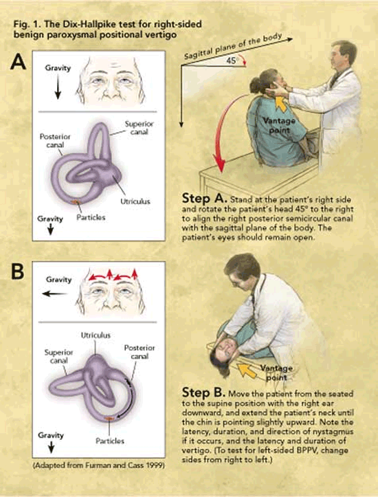 Hallpike Dix Test Bppv Hallpike Dix Test Bppv