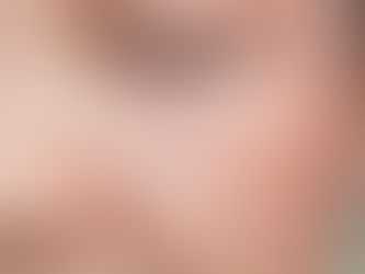 【推荐吉隆坡及柔佛 新山专业整形/微整医院】避开治疗黄褐斑的误区,正确治疗看这里!