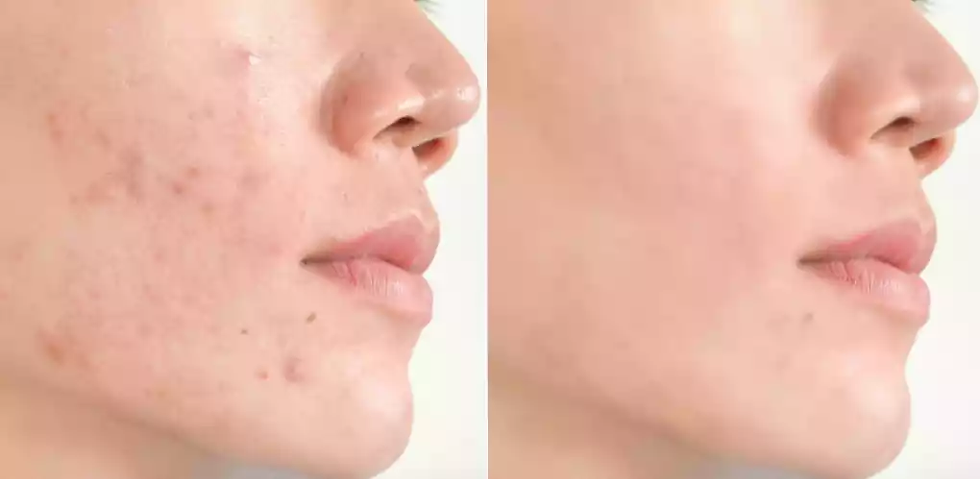 PRP (Platelet Rich Plasma)前后比对 - 提升肌肤的状态 ,延缓皮肤老化的作用