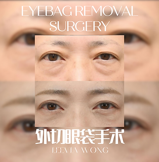 JB eyebag surgery JB眼袋手术 JB内吸眼袋26.png