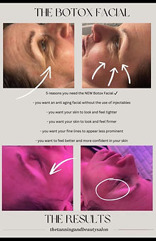 botox facial, facial,advanced facial, new, essex