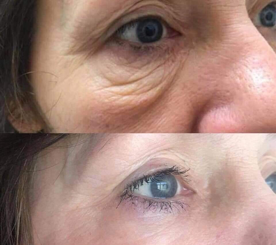 Thumbnail: Deept Tissue Monopolar Radiofrquency