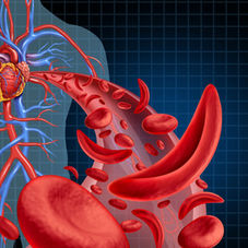 Understanding Sickle Cell Disease