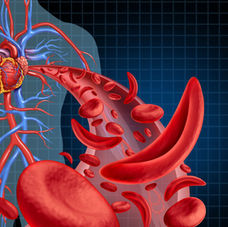 Understanding Sickle Cell Disease