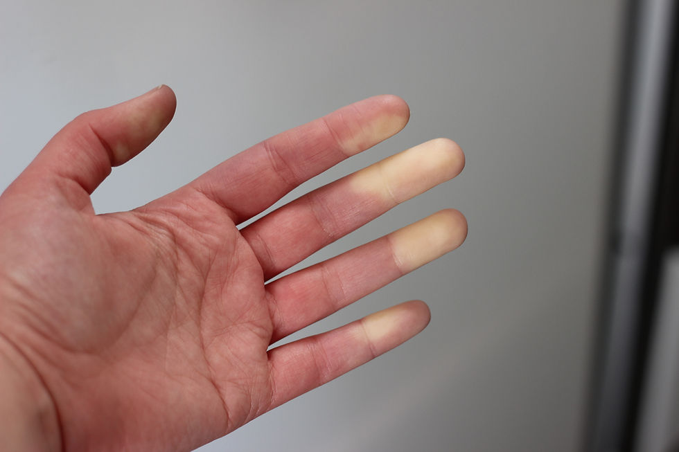 Close-up of a hand showing signs of vibration white finger, a condition linked to Hand Arm Vibration Syndrome (HAVS) caused by prolonged use of vibrating tools.