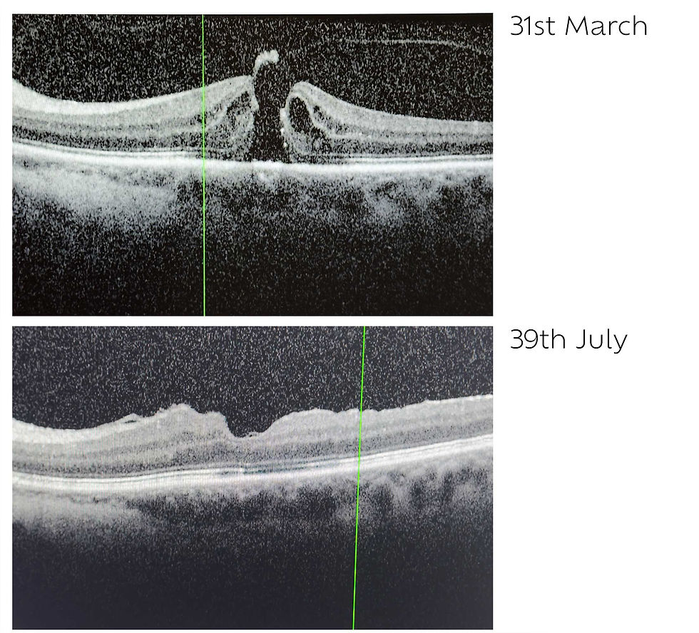 Before and after scans of maclar hole successfully closing after vitrectomy 8 weeks post operation