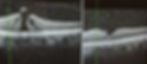 before and after scan of my macular hole