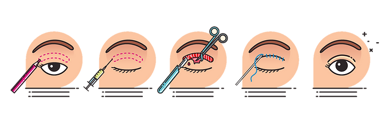 schema-blepharoplastie.png