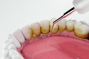 dental-cleaning-removing-plaque-dirt-teeth-3d-3d-illustration-1024x683.jpg