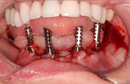 all on 4 implant restoration