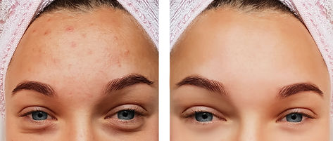 Acne (1).jpeg