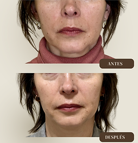 Rejuvenecimiento facial Valencia