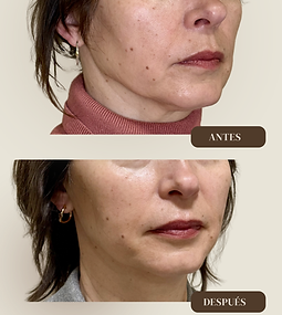 Lifting facial Valencia