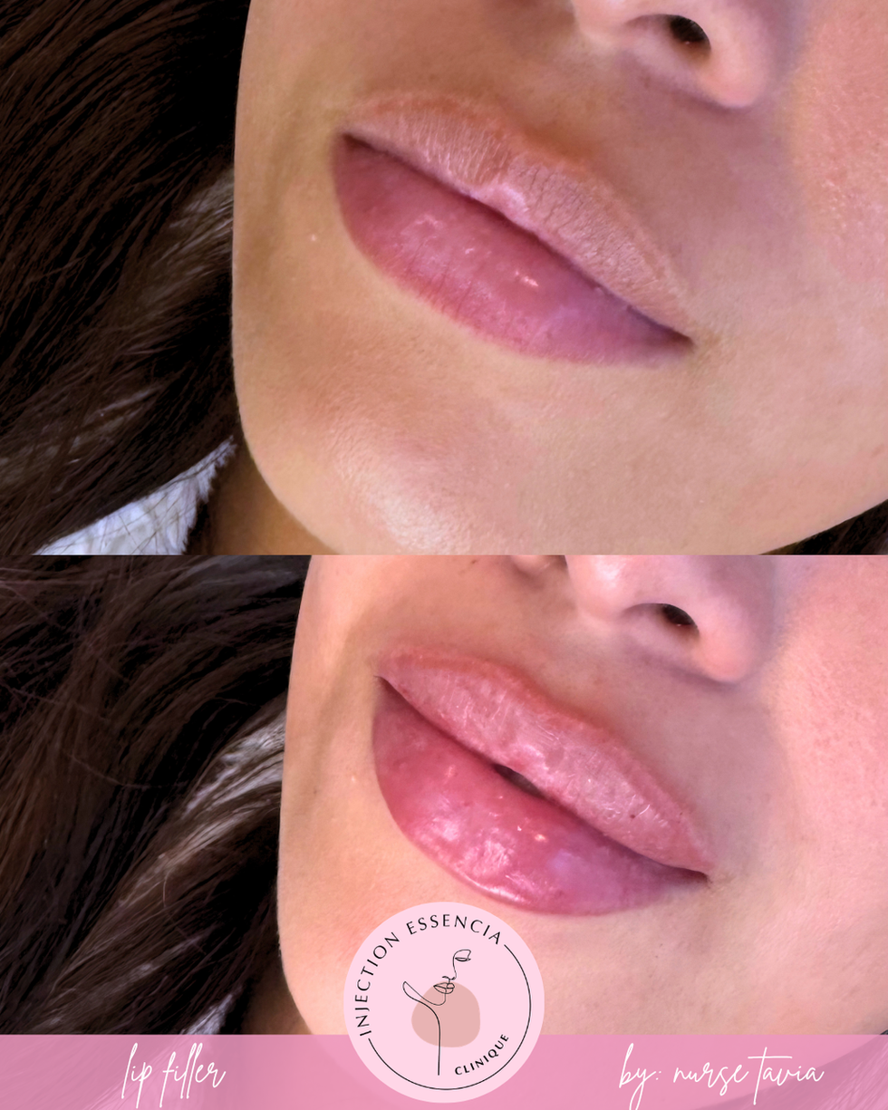 Avant-après d’un lip filler réalisé par Nurse Tavia, montrant une amélioration du volume, de l’hydratation et de la définition des lèvres.