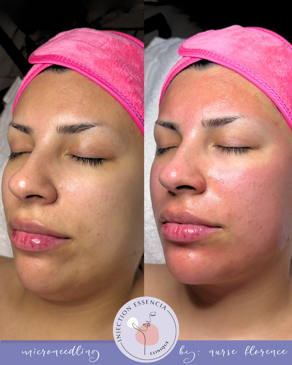 Avant-après d’un microneedling réalisé par Nurse Florence, montrant une peau plus lumineuse, lisse et éclatante.