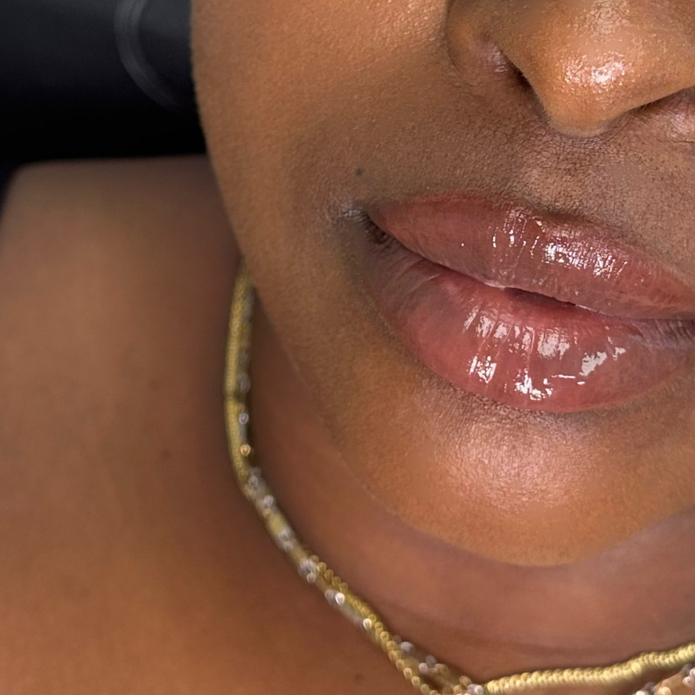 Résultat cicatrisé d’un traitement équilibré des lèvres à la Clinique Injection Essencia à Longueuil, harmonisant les proportions pour un look frais et naturel.