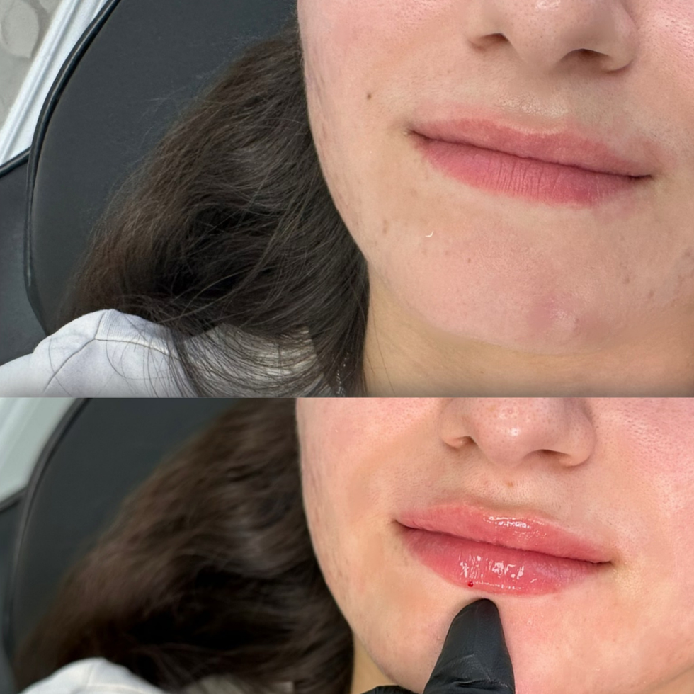 Before and after of a lip filler treatment focused on gentle volume and harmonious enhancement, performed in Longueuil.
