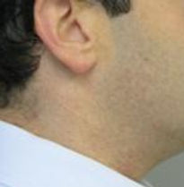 After Orthognathic Surgery