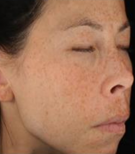 Before microneedling with Pura Derma Stamp