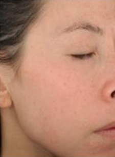 After Microneedling with Pura Derma Stamp