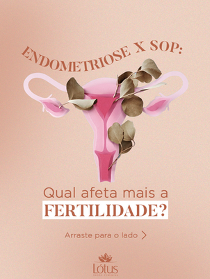 Endometriose X SOP: Qual afeta mais a fertilidade?