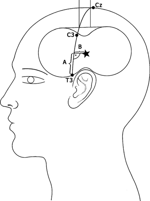 Estimulação Magnética Transcraniana para o tratamento de Tinitus