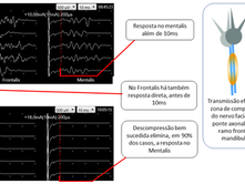 Monitorização intra-operatória em descompressão microvascular para espasmo facial