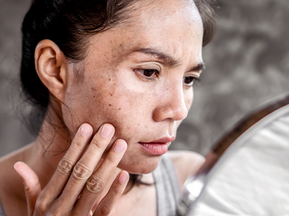 Hyperpigmentation: Why It Happens and How to Treat It