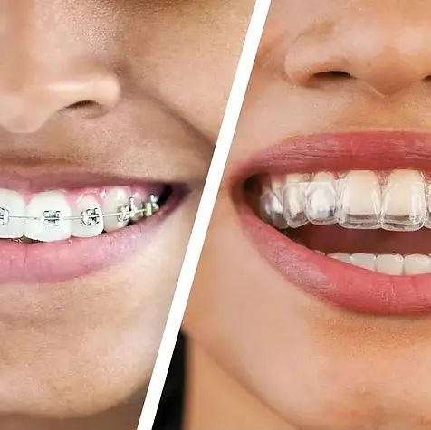 dental-braces-vs-invisalign.webp